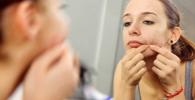 Top 10 Myths About Acne