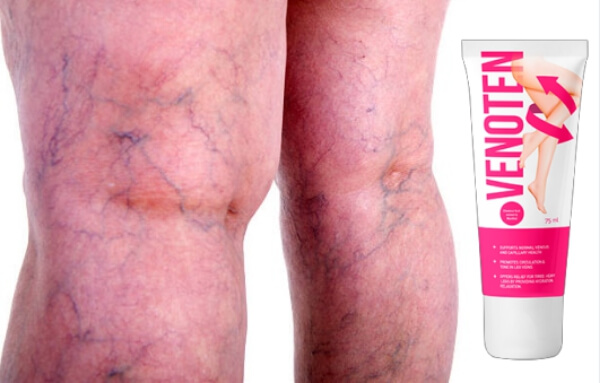 cream, varicose veins