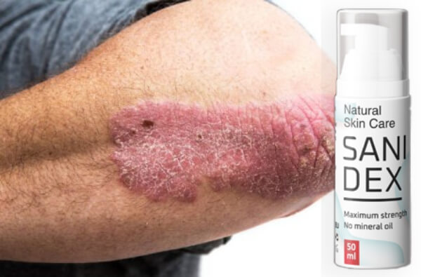 sanidex cream, psoriasis