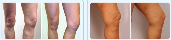 Varicose Veins 