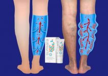 Sunsara Review – All-Natural Gel for the Active Elimination of Varicose Veins