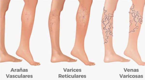  Varicose Veins