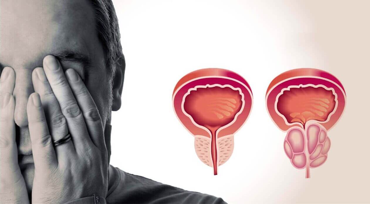  Protect the Prostate Gland from Hyperplasia and Prostatitis