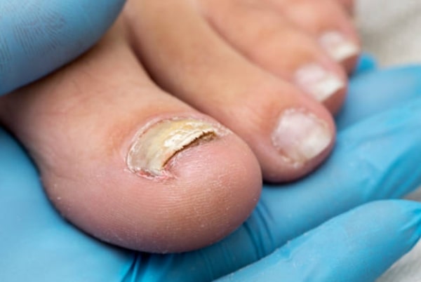 Onychomycosis, Infection