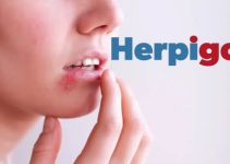 HerpiGo – Is It a Working Product? Reviews, Price?