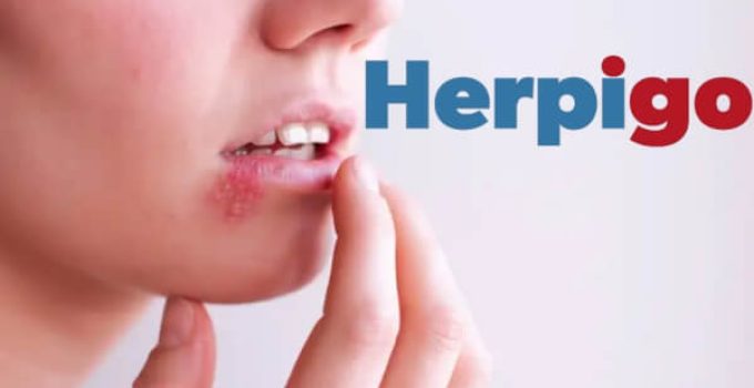 HerpiGo – Is It a Working Product? Reviews, Price?